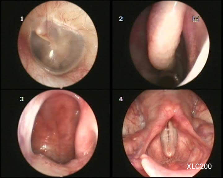 máy nội soi tmh