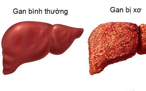Máy siêu âm đàn hồi mô gan Giải pháp tối ưu cho chẩn đoán bệnh gan